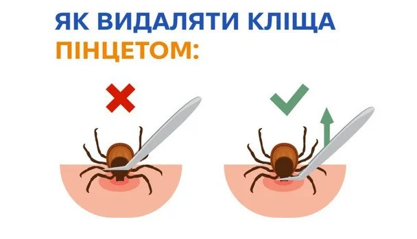 Кліщ уже присмоктався, а медичного закладу поблизу немає: як впоратися з цим самостійно та що суворо заборонено робити 4 Видалення кліща пінцетом / © Центр громадського здоров’я МОЗ України