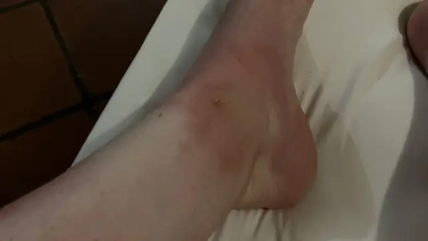 A person's foot in profile, partially wrapped in a white towel; the skin near the ankle shows minor redness or rash, bruising, and swelling.