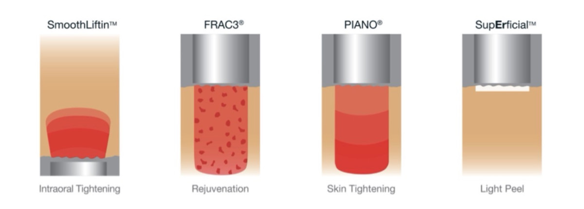 Fotona4D®: The Laser Treatment Beloved by Celebrities and Dermatologists Alike2