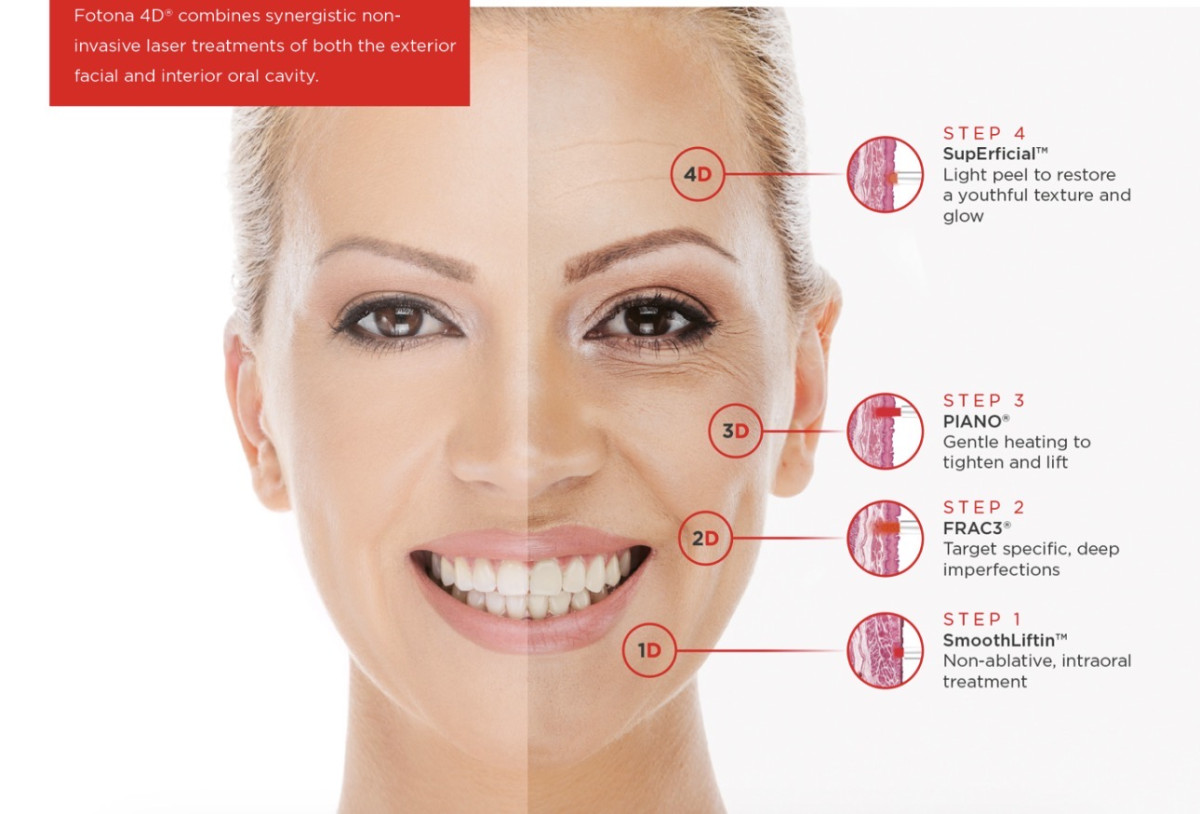 Fotona4D®: The Laser Treatment Beloved by Celebrities and Dermatologists Alike1