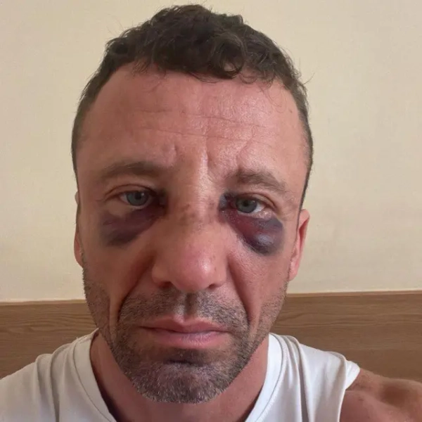На фотографії Кирило після того, як його побили 