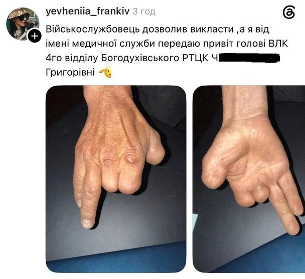 Військово-лікарська комісія на Харківщині визнала чоловіка, який втратив три пальці на руці, придатним до військової служби, як повідомляють соціальні мережі. 7